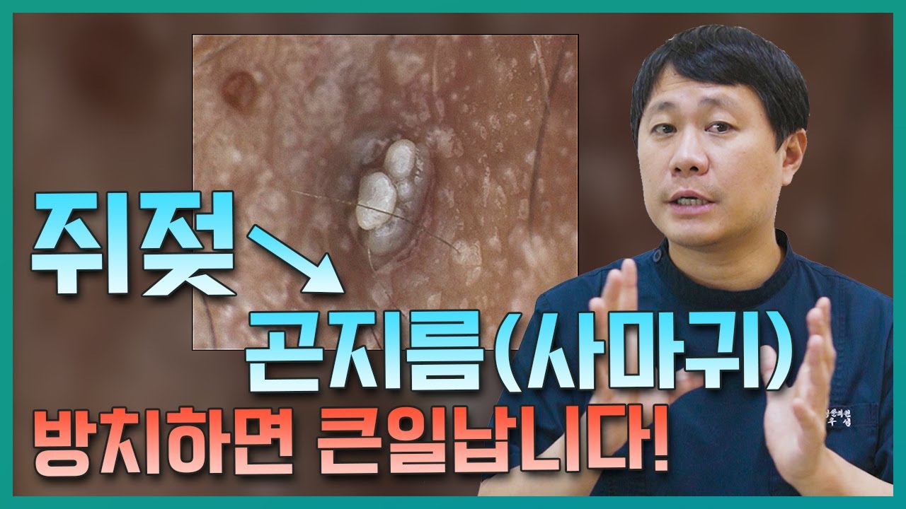 인유두종바이러스 사마귀 (곤지름) 재발, 이렇게 막을 수 있어요! | #자궁경부암 #자궁경부암백신 - Youtube